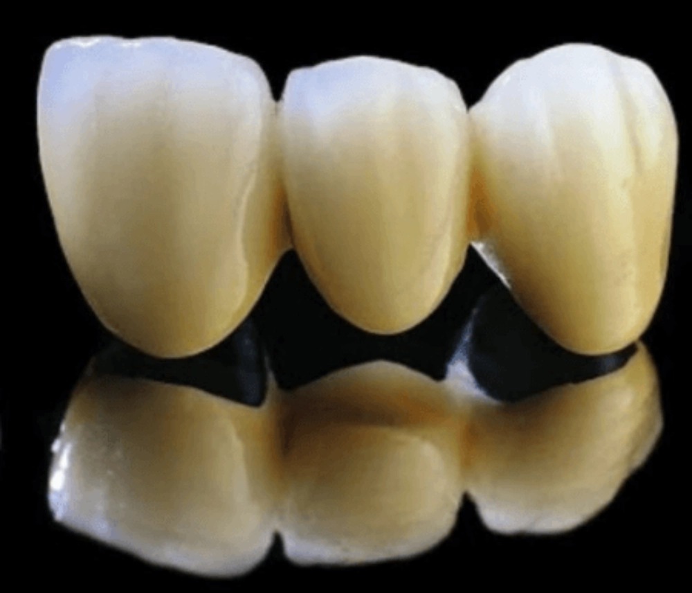 Răng sứ kim loại là gì? Phân loại và ưu nhược điểm